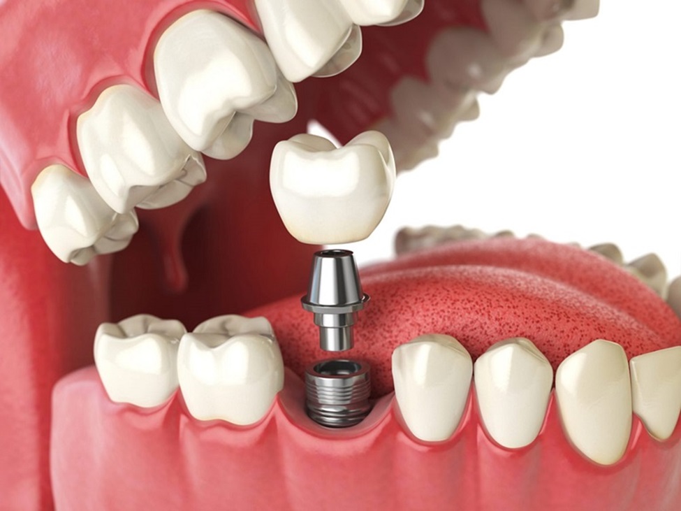 What Are the Most Popular Dental Implants