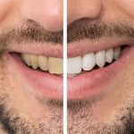 Tooth Discoloration